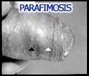 Parafimosis